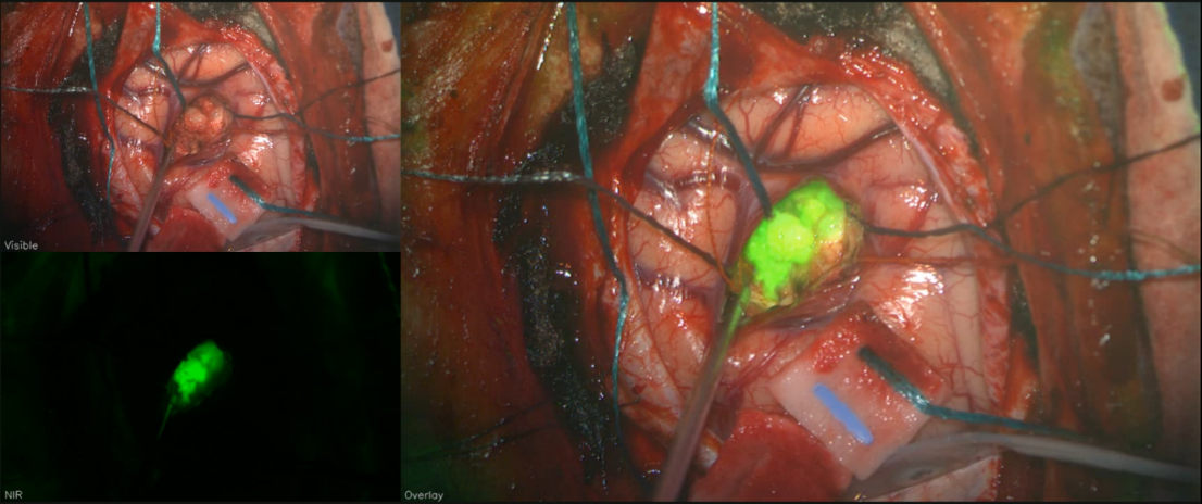 CANVAS® intraoperative imaging — three views: standard visible light, near-infrared fluorescence, and overlay showing tumor highlighted by tozuleristide