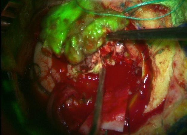 Intraoperative CANVAS® imaging — tozuleristide (BLZ-100) illuminates tumor tissue green during brain surgery